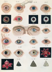 Beschrijving van aangeboren oogafwijkingen, uit Klinische Darstellungen der Krankheiten und Blidungsfehler des Mesnschlichen Auges, door Friedrich August von Ammon (1799-1861) 1838