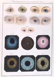 Beschrijving van aangeboren oogafwijkingen, uit Klinische Darstellungen der Krankheiten und Blidungsfehler des Menschlichen Auges, door Friedrich August von Ammon, 1838