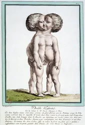 Siamese kinderen - in "Les déviations de la nature" door Régnault