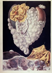 Kanker - van Cruveilhier