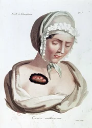 Anthracine kanker - Alibert, B.N.