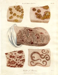 Pathologische huidveranderingen: Verscheidenheden van psoriasis