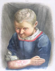 Favus, uit een boek door Daniel Cornelius Danielssen, 1892