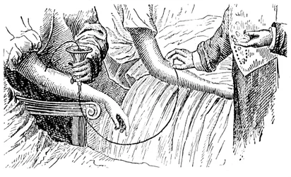 Bloedtransfusie, ca. 1880