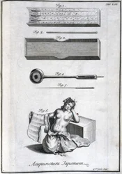 Alternatieve geneeskunde: plaat met acupunctuurnaalden en hun toepassing, gravure uit 