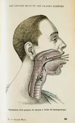 Gebruik van een laryngoscoop om een poliep uit de keel te verwijderen, ca. 1890