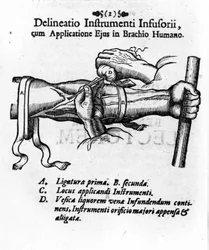 Intraveneuze injectie met een klysma blaas. door J. D. Mayor, 