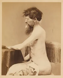 Soldaat John Bar, Herstel na een penetrerende buikwond met breuk van de linker Os Innominatum, uit de fotocatalogus van de chirurgische afdeling